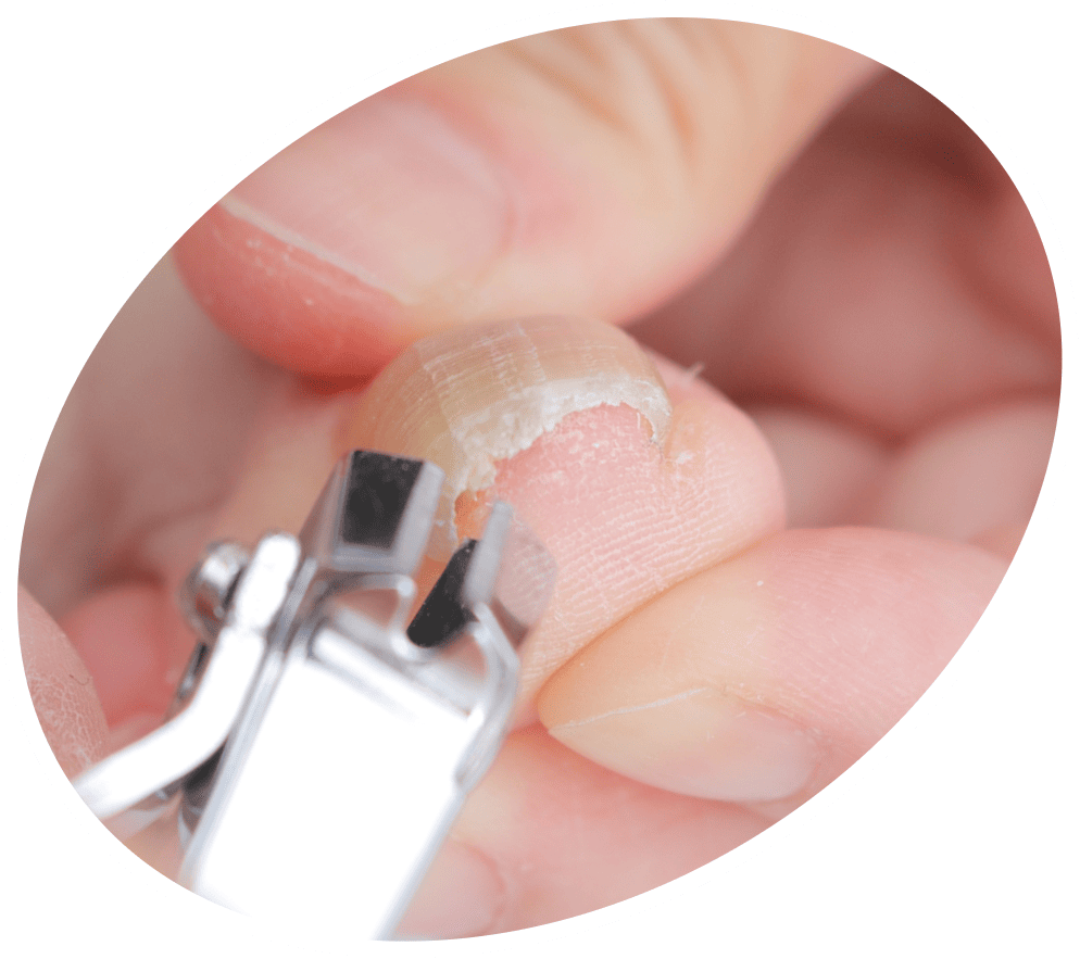 ドーム型の巻き爪