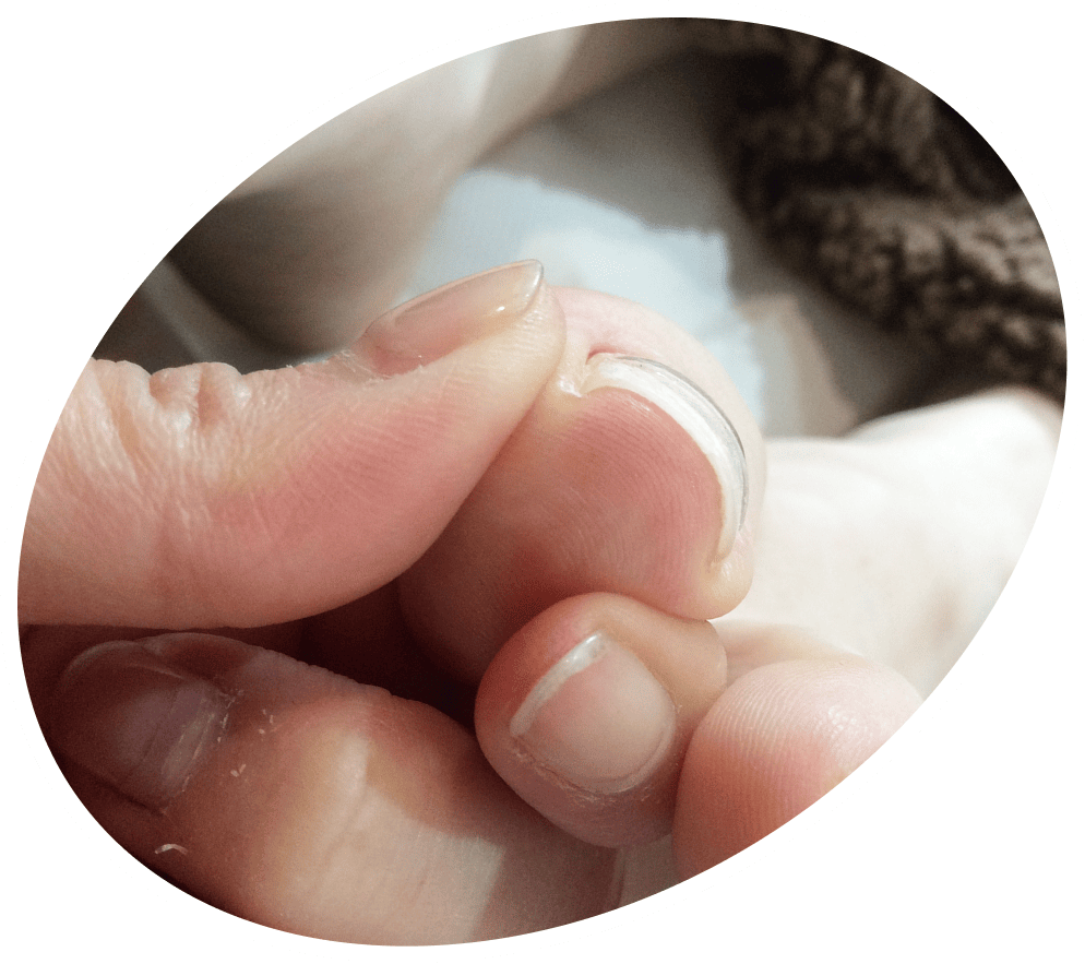 ストロー型の巻き爪