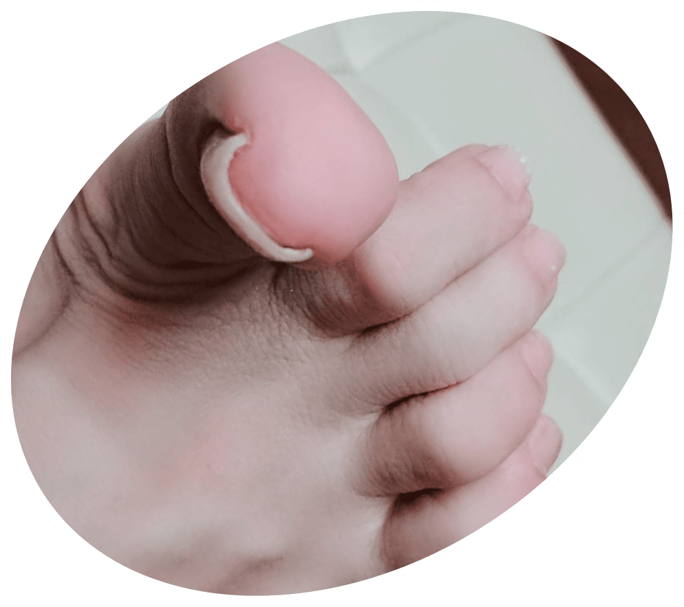 ホッチキス型の巻き爪