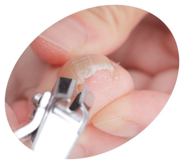 ドーム型の巻き爪