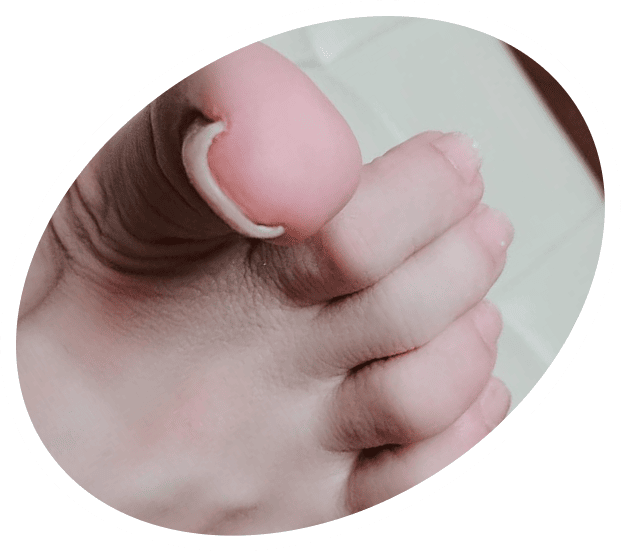 ホッチキス型の巻き爪